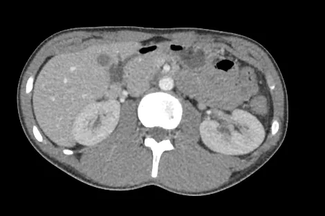 Axial CT scan of the abdomen at the level of L1